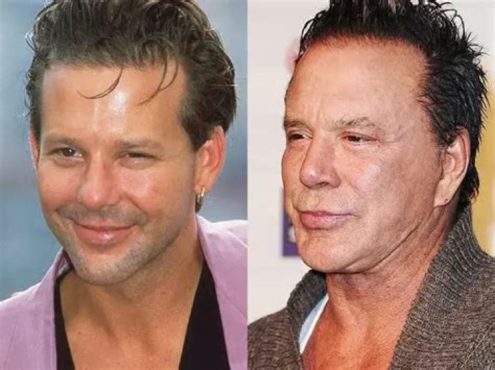 All You Need To Know About Mickey Rourke's Face surgery