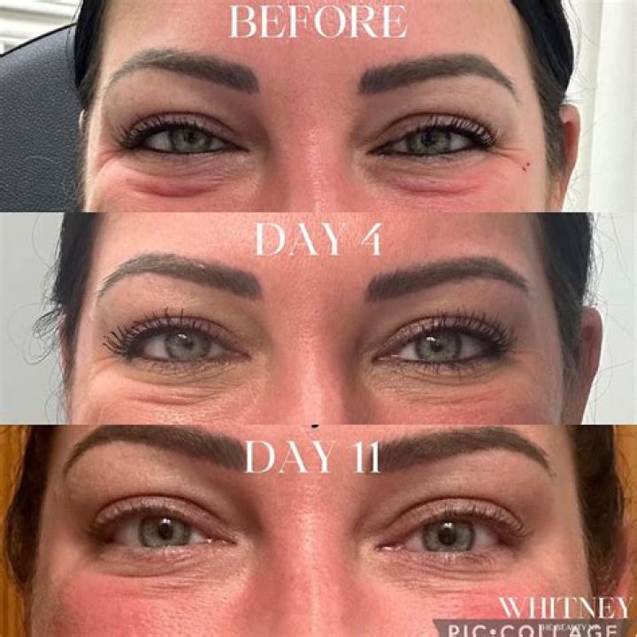 Unlock The Secrets Of Botox Jelly Roll: Before And After Revealed