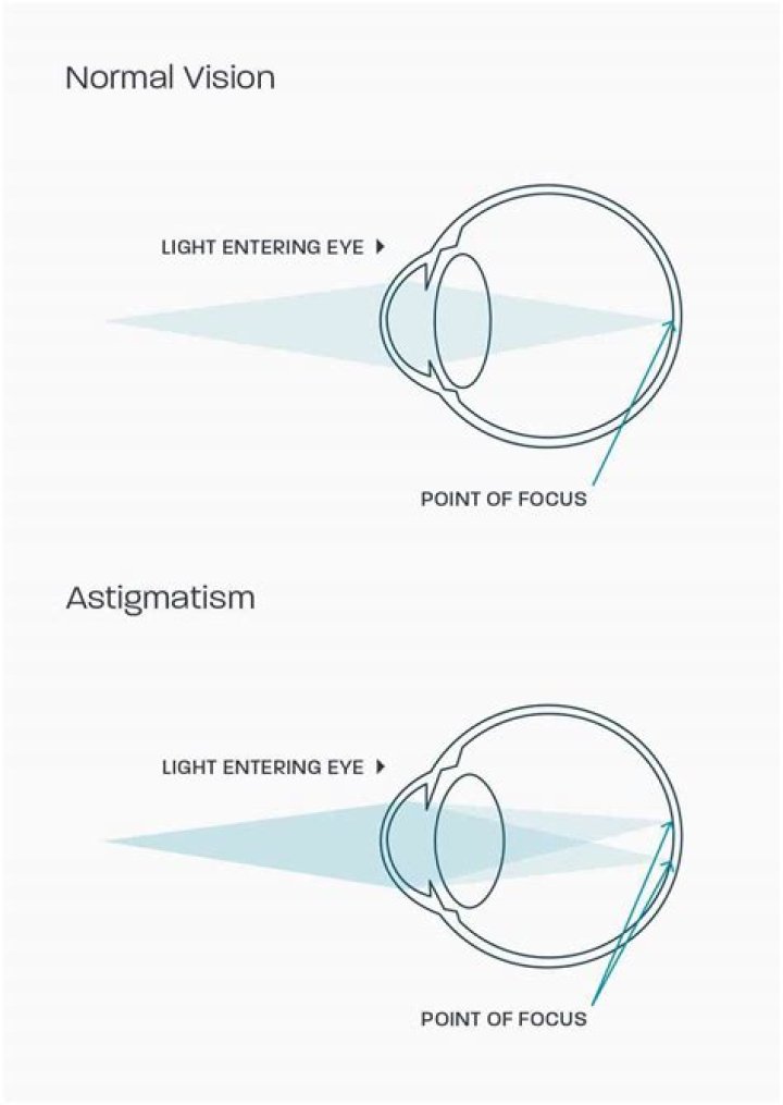Unlocking The Secrets Of Astigmatism
